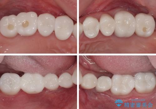 かかりつけ医の治療方針に疑問　歯周病治療と矯正治療を合わせた総合歯科治療の治療後