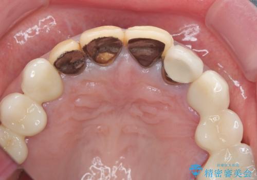 保険適応 硬質レジン前装冠から審美的でオールセラミッククラウンへの治療前