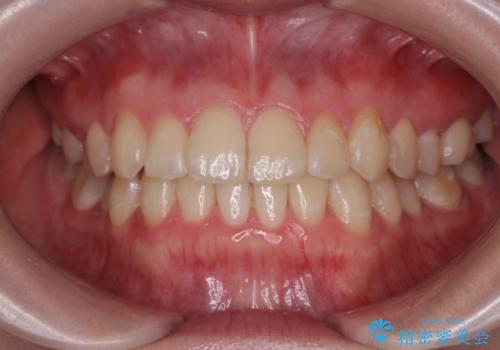 [ インビザラインライト ]  短期間で行う前歯のマウスピース治療の治療後
