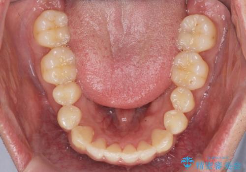 [ インビザライン矯正 ]  マウスピースで治す、すきっ歯　がたつきの治療後