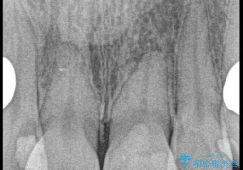 転んで折れた前歯セラミック治療で審美改善の治療中