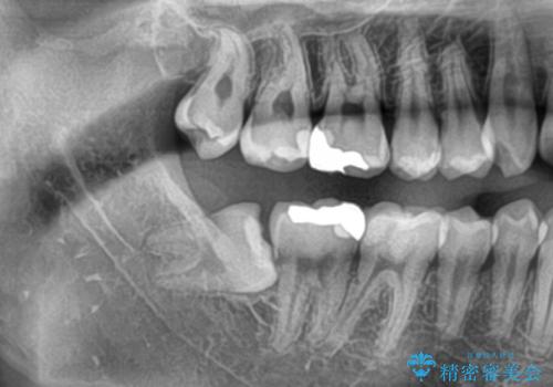 親知らずを抜きたいの治療前