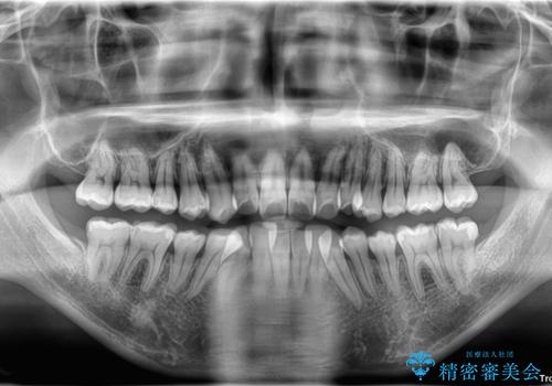 下顎の叢生を抜歯矯正で改善|費用を抑えたメタルブラケット矯正の治療前