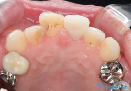 転んで折れた前歯セラミック治療で審美改善の治療後