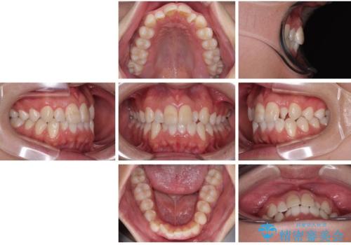 マウスピース矯正と迷った結果…管理のしやすさで選んだクリアブラケット矯正の症例の治療前