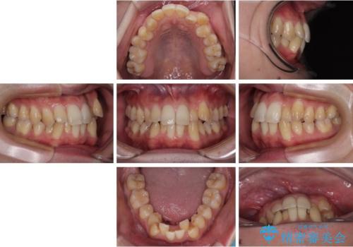 下顎の叢生を抜歯矯正で改善|費用を抑えたメタルブラケット矯正の治療前