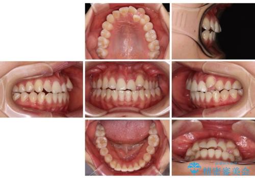 急速拡大装置 狭い上顎歯列を改善して、八重歯を改善した片側抜歯矯正治療の治療前