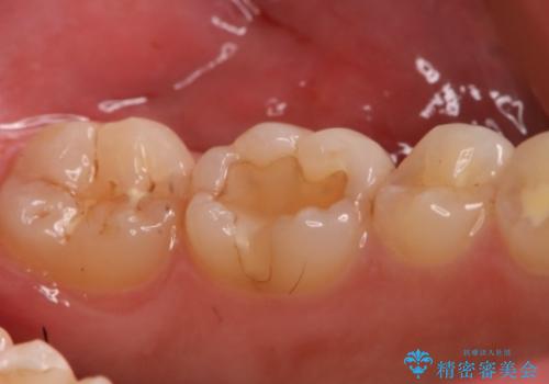 奥歯にセラミックを入れたい セラミックインレーの治療前