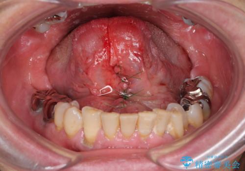 『舌小帯形成術』 ベロの動きを良くして滑舌を改善したいの治療中
