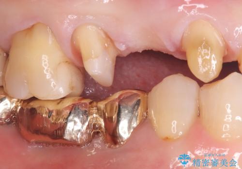 【セラミッククラウン】歯が欠けた!の治療中