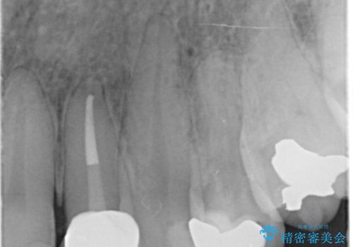 [ ジルコニアセラミッククラウン] 神経の死んだ前歯の治療の治療後