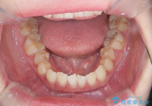 [ インビザラインライト ]  短期間で行う前歯のマウスピース治療の治療前