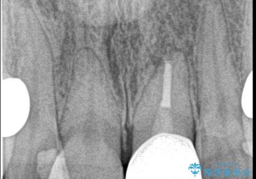 転んで折れた前歯セラミック治療で審美改善の治療後