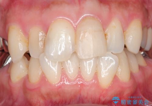 転んで折れた前歯セラミック治療で審美改善の治療中