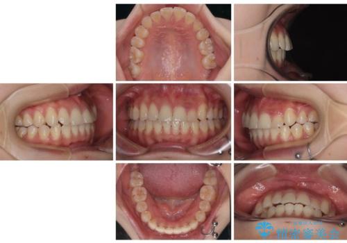 急速拡大装置　狭い上顎歯列を改善して、八重歯を改善した片側抜歯矯正治療の治療後