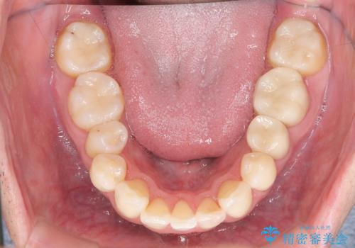 全ての銀歯を外すメタルフリー治療 + 歯並びをきれいにする矯正治療の治療後