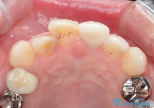 転んで折れた前歯セラミック治療で審美改善の治療後