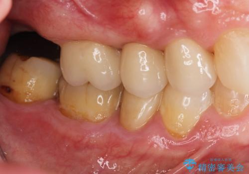 過大な力で折れた失活歯 セラミックブリッジ治療の治療後