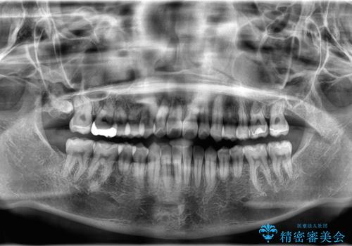 「歯を抜かずに、たった10ヵ月。」目立ちにくい大人の矯正の治療後