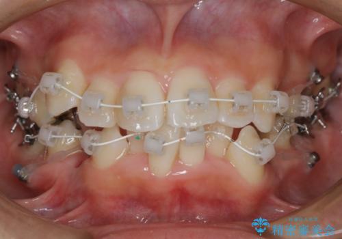 出っ歯が気になる　抜歯+ワイヤー矯正治療の治療中