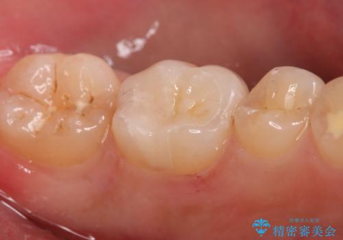 奥歯にセラミックを入れたい セラミックインレーの治療後
