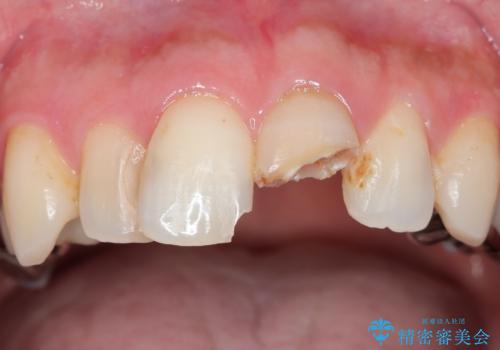 転んで折れた前歯セラミック治療で審美改善の治療前