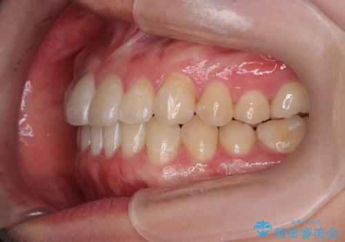 [ インビザラインライト ]  短期間で行う前歯のマウスピース治療の治療後