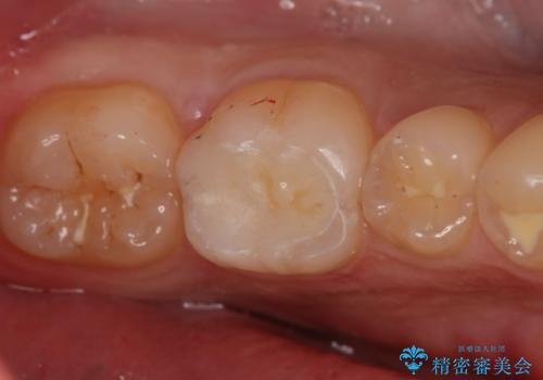 奥歯にセラミックを入れたい　セラミックインレー
