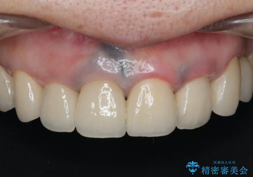 保険適応 硬質レジン前装冠から審美的でオールセラミッククラウンへ