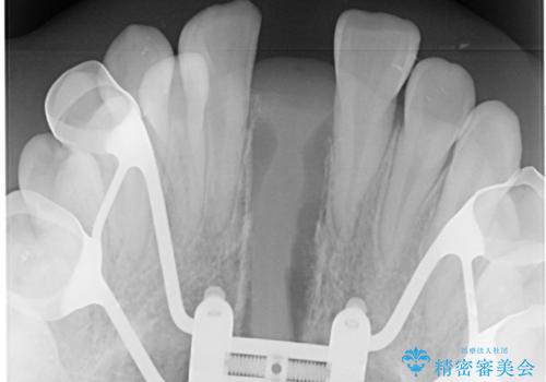 急速拡大装置 狭い上顎歯列を改善して、八重歯を改善した片側抜歯矯正治療の治療中