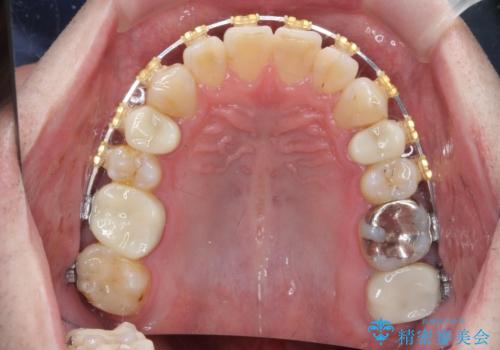 全ての銀歯を外すメタルフリー治療 + 歯並びをきれいにする矯正治療の治療中