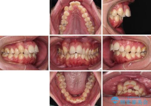 狭くて前方に飛び出した歯列　拡大装置を併用したワイヤー抜歯矯正治療の治療前