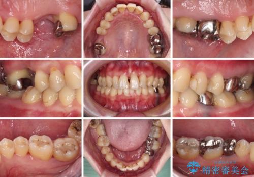 かかりつけ医の治療方針に疑問　歯周病治療と矯正治療を合わせた総合歯科治療の治療前