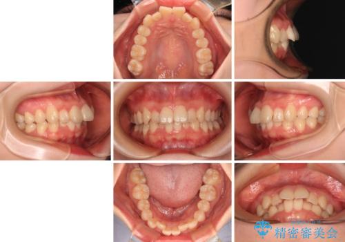飛び出した前歯を引っ込める ワイヤー装置の非抜歯矯正の治療前