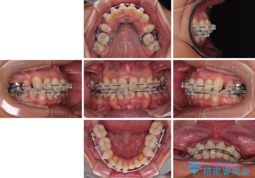 矯正治療途中で転院　遠方への転勤で通院困難な方の矯正治療の治療前