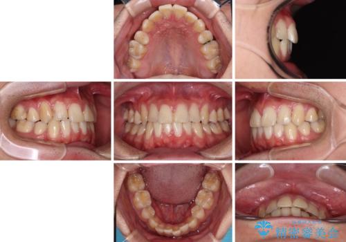 矯正治療の後戻り　インビザライン・モデレートパッケージで短期間治療の治療前