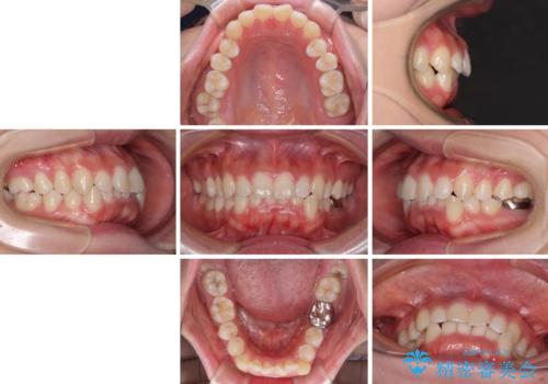 口ゴボが気になる　上下4本の抜歯矯正の治療前