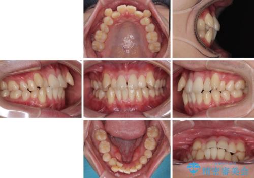 八重歯と重なった前歯　目立たない装置での抜歯矯正の治療前