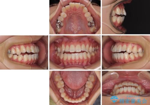 舌の突出癖が原因　インビザライン矯正による開咬改善の治療前