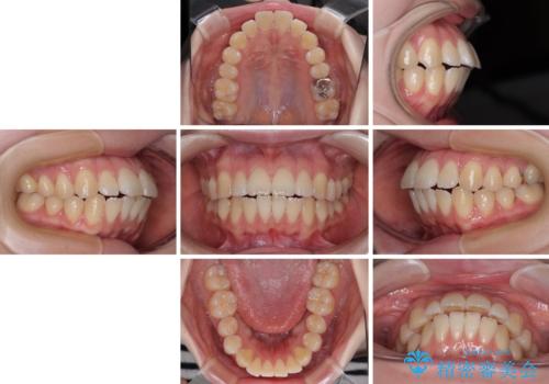飛び出した前歯を引っ込める　ワイヤー装置での抜歯矯正治療の治療前
