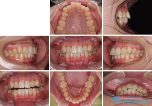 インビザラインの自己管理は煩わしい ワイヤー矯正で短期間矯正治療の治療前