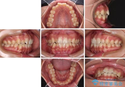 デコボコと捻れて前に飛び出した歯列 抜歯矯正でスッキリした口元にの治療前