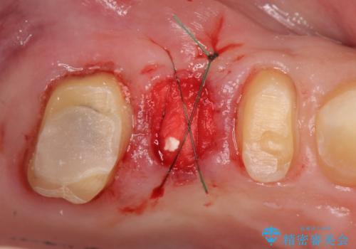 過大な力で折れた失活歯 セラミックブリッジ治療の治療中