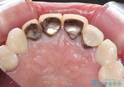 保険適応 硬質レジン前装冠から審美的でオールセラミッククラウンへの治療前
