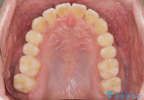 [ インビザライン矯正 ]  マウスピースで治す、すきっ歯　がたつきの治療後