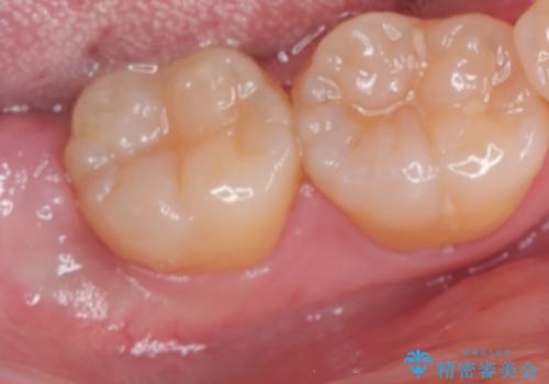 親知らず抜歯の治療前