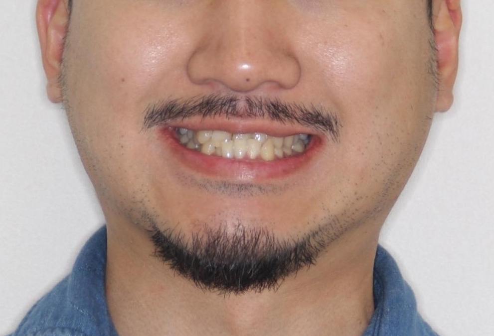 【ワイヤー矯正】かみ合わせを治したいの治療前(顔貌)