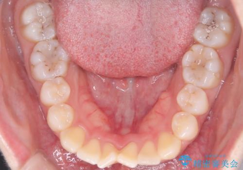 【ワイヤー矯正】前歯の突出感、下の歯の並びを良くしたいの治療前