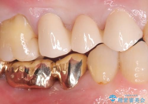 【セラミッククラウン】歯が欠けた!の治療後
