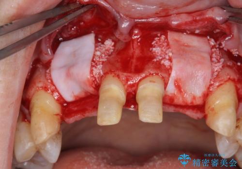 [ 全て歯を抜かなければいけないと言われた] 矯正治療を含む包括的歯周病治療の治療前